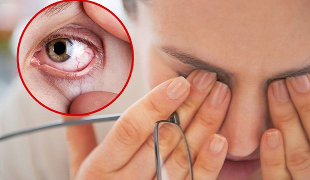 Các bệnh về mắt phổ biến thường gặp