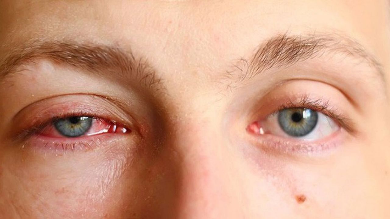triệu chứng của bệnh đau mắt đỏ