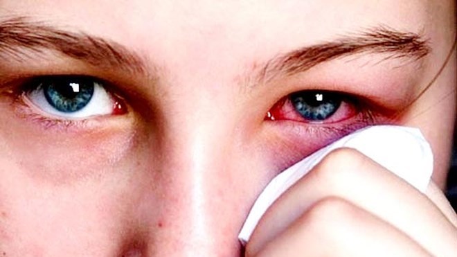 Người bị đau mắt đỏ cần kiêng gì để bệnh nhanh khỏi?