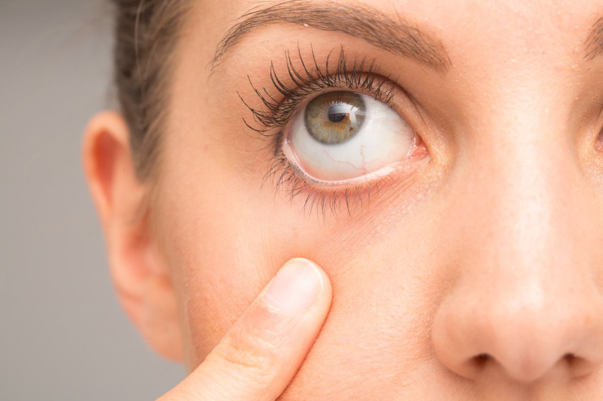 Khô mắt mỏi mắt: Nguyên nhân, biểu hiện, cách cải thiện