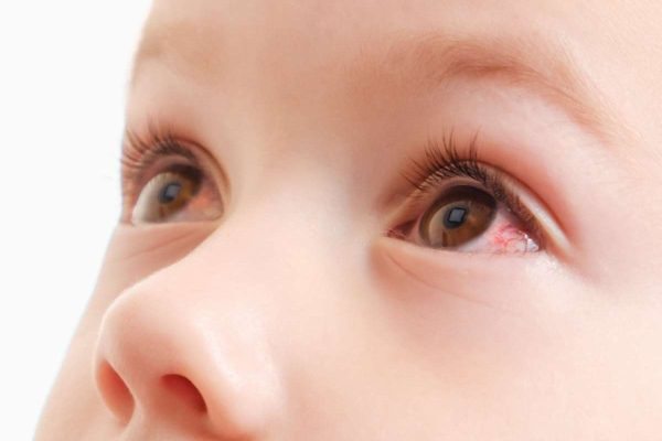 chăm sóc trẻ bị đau mắt