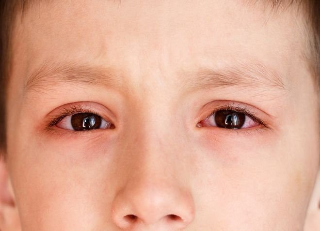 chăm sóc trẻ bị đau mắt