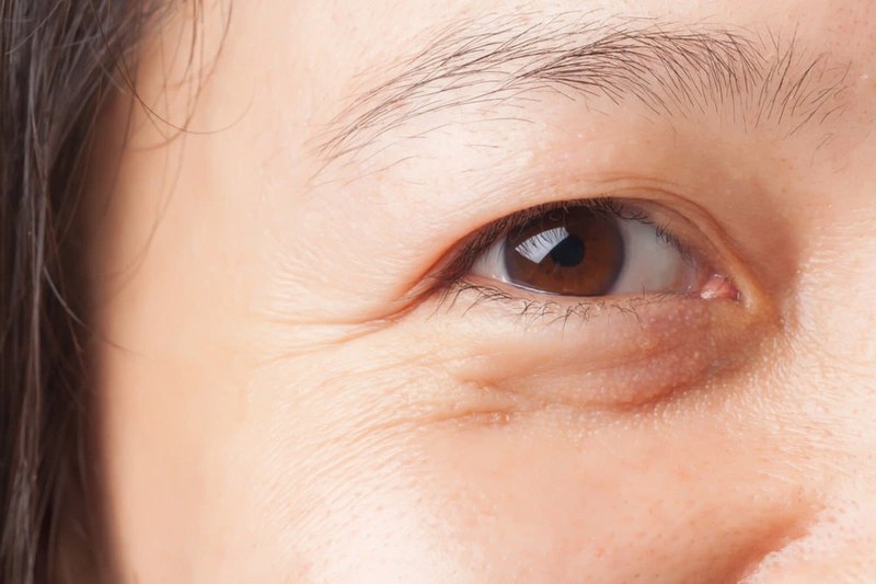 bệnh lão hóa mắt