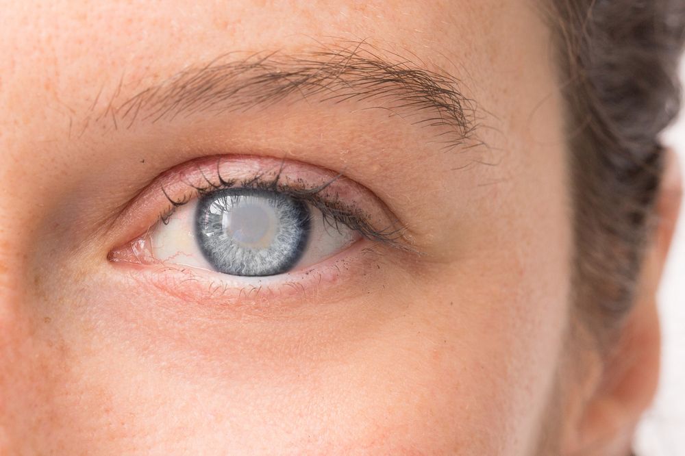 Phương pháp chăm sóc mắt sau mổ đục thủy tinh thể